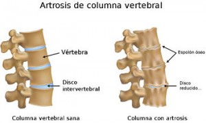 artrosis y acupuntura