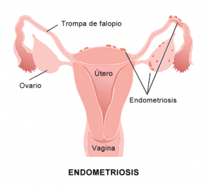 endometriosis-v2